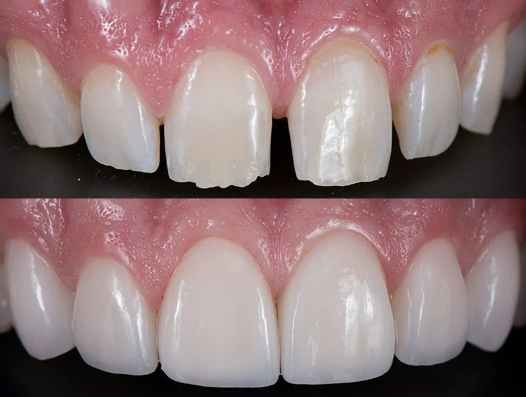 Veneers result — Southwater Dental Practice