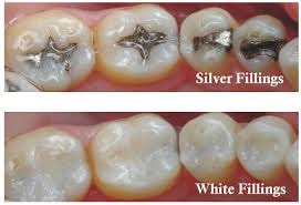 White fillings result — Southwater Dental Practice