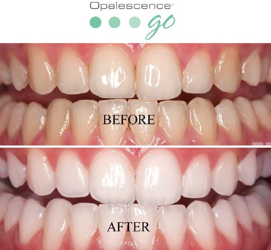 Teeth whitening result — Southwater Dental Practice